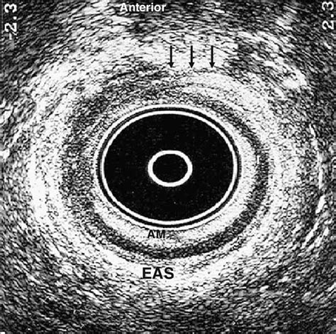 Endoanal Ultrasound Image Demonstrating An Overlap Repair Arrows Of Download Scientific