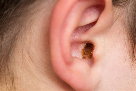 Managing Ear Wax In Children A Guide For Parents And Carers Bright