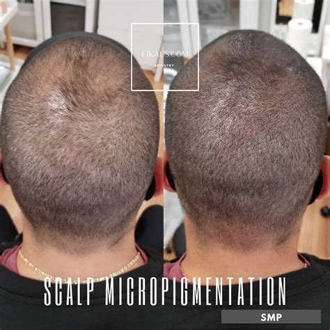Scalp Micropigmentation Smp For Hair Loss In Anchorage Ak —