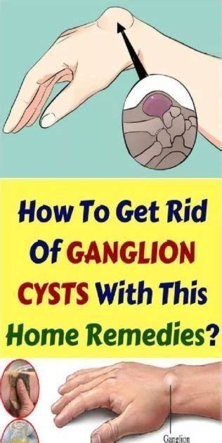 How To Get Rid Of Ganglion Cysts With This Home Remedies Medicine
