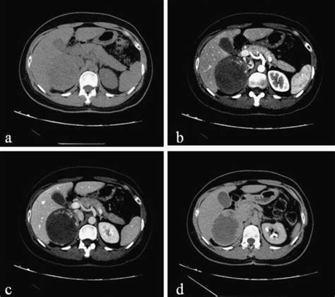 A Noncontrast Enhanced Ct Scan Showing Encapsulate Large Right