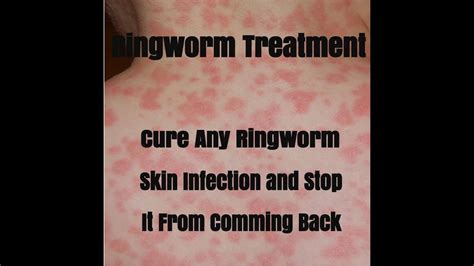 What Is Ringworm What Is Ringworm Causes Symptoms And Treatment