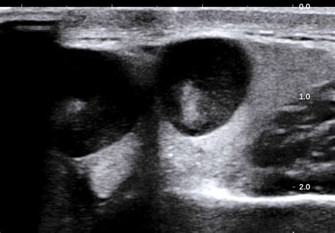 Vietnamese Medic Ultrasound Case 469 T Cell Lymphoma Of Submandibular