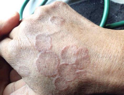 Image Of The Week Ring Shaped Lesions On The Hands Clinical Advisor
