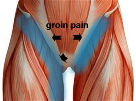 In human anatomy, the groin (the adjective is inguinal, as in inguinal canal) is the junctional area (also known as the inguinal region) between the abdomen and the thigh on either side of the pubic bone. Groin Pain, Groin Strain Treatment. Upper Thigh Pain, Hip ...