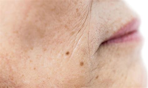 Elderly Bruised Skin What Causes It And How To Prevent It Elderly Guides