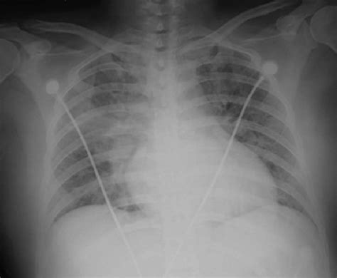 Chest X Ray On Admission Showed Bilateral Pulmonary Edema Download