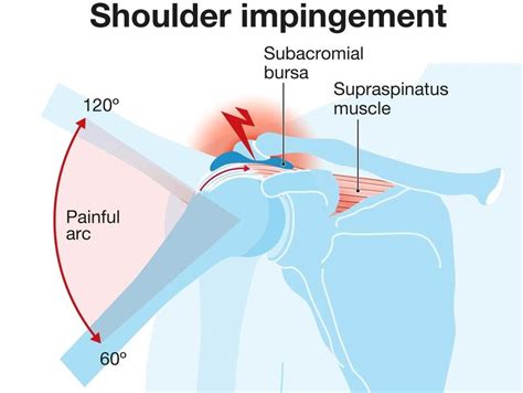 Shoulder Impingement Syndrome Causes Symptoms And Treatment