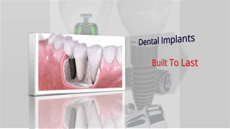 Supplemental dental insurance can be a wise move to maintain a strong oral hygiene routine, even if you have medicare. Dental Implants Bluffton SC| Off-Island Dental Care SC| Dental Implants Periodontist - YouTube
