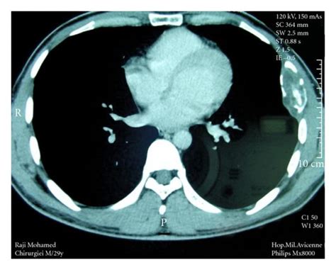 Chest Ct Scan Tumor Of The 6th Left Rib Without Invasion Of Adjacent