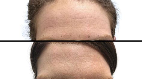 Botox Dysport Jeuveau Xeomin Chicago Cosmetic Surgery And Dermatology