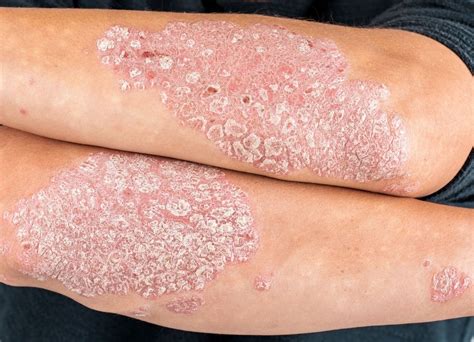 What Is Psoriasis And What Are The Symptoms And Treatment Western