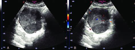 Ultrasound Showed A Hypoechoic Mass The Mass Had A Clear Boundary A