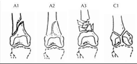 Fracture Classification According To The Ao System Download