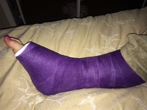 Broken Ankle Purple Cast Pink Toes Cast Guy Flickr