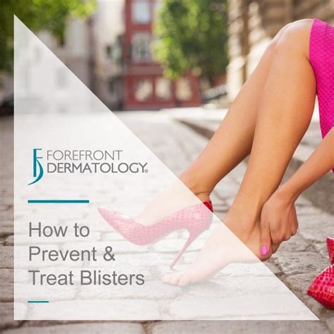 How To Prevent And Treat Blisters Forefront Dermatology