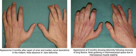 19 Tendon Transfers For Ulnar Nerve Palsy Clinical Gate