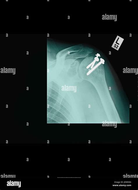 X Ray Showing Shoulder Screws Stock Photo Alamy