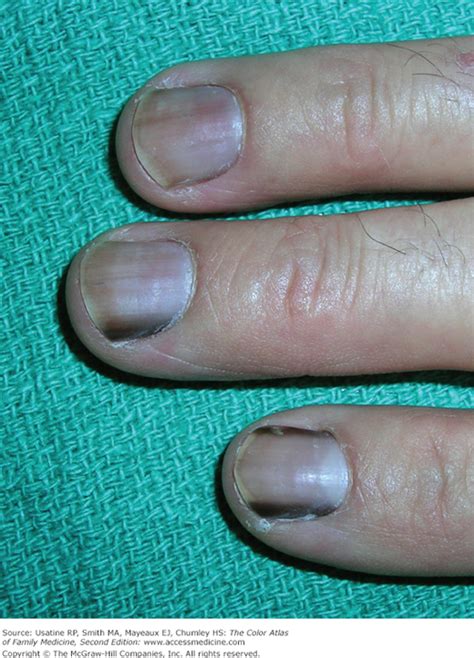 Pigmented Nail Disorders Basicmedical Key