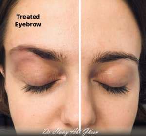 The pdo threadlift consists of introducing multiple very gentle threads in an area with 2 actions in mind: Cat Eye Thread lift - Dr Hany Abi Ghosn