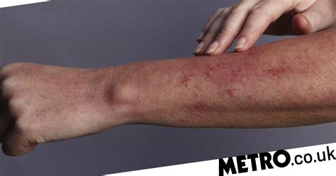 Skin Rashes Could Be Added To Nhs Official List Of Symptoms Diabetes Uk