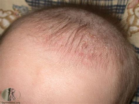 Seborrheic Dermatitis Scalp Infant