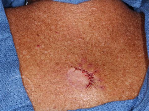 Chasing Margins Of Melanoma In Situ Of Back Skin Cancer And