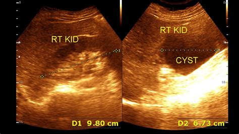 Ultrasound Cases 74 Of 2000 Video Showing Renal Cortical Cyst Youtube