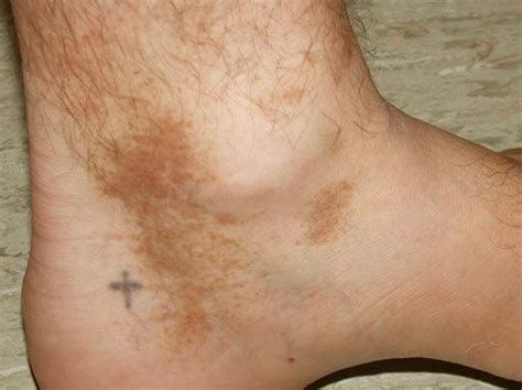 Brown Spots On Ankles Pictures Photos