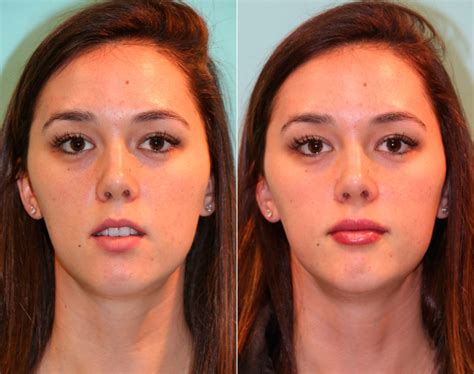 lip augmentation before and after photos page 3 of 6 the naderi center for plastic surgery