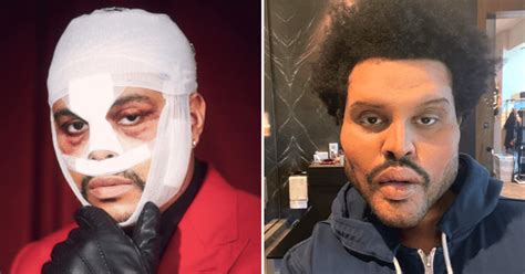 Did The Weeknd Get Plastic Surgery Truth Behind Botox Rumors As Trolls