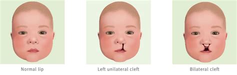 Cleft Lip Fact Sheet Childrens Health Queensland