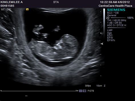 Lillie Mae 10 Week Ultrasound Picture