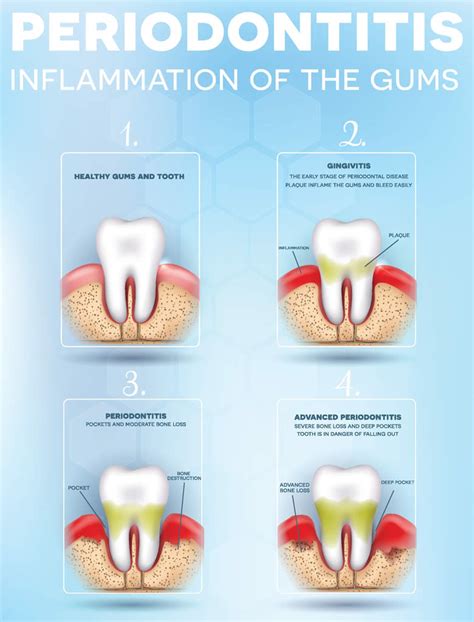 Gum Disease How To Get Healthy Gums Teeth Larry Saylor Dentistry