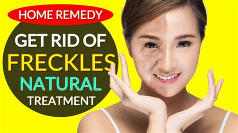 best freckle removal treatment how to get rid of freckles at home youtube