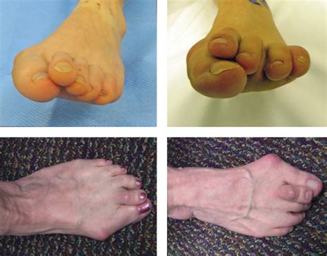 Correction Of Lesser Toe Deformity Musculoskeletal Key