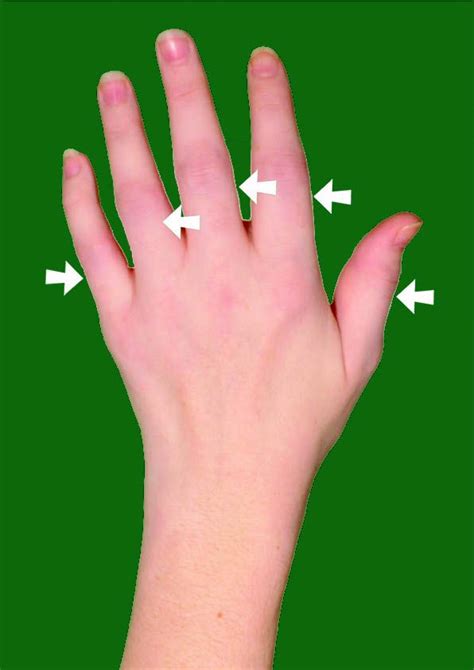 Public Tutorial Health Tips Finger Joint Ankylosing