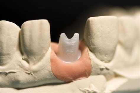 Dental Implant Restoration In Phoenix Az Central Valley Dentistry