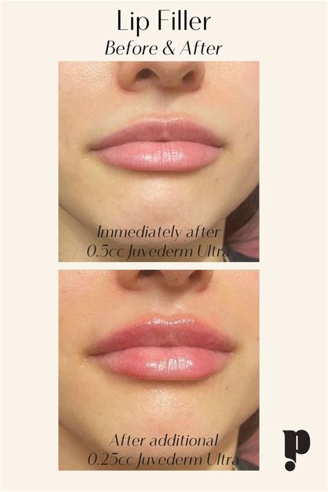 Before And After Lip Filler 75 Cc Of Juvederm Ultra Lip Fillers Lip