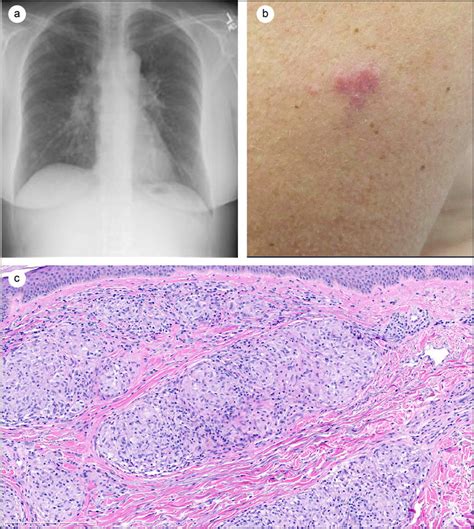 A Chest X Ray Demonstrating Prominent Hilar Lymphadenopathy And
