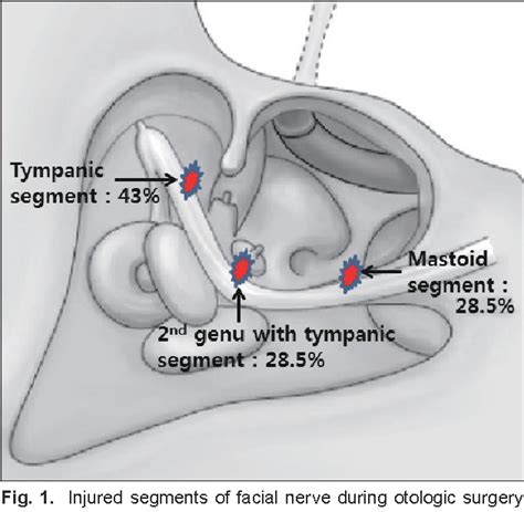 Mastoidectomy Anatomy