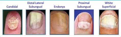 Fungal Nail Infection Eliminaser