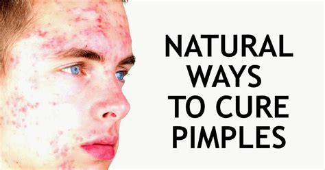How To Cure Pimple Naturally ~ Inspire Me