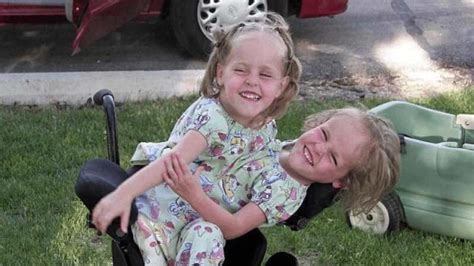 Conjoined Twins Separated In Risky Surgery 13 Years Ago Are Now Thriving With Only One Leg Each