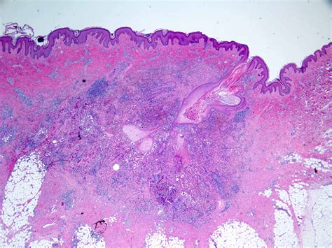 Pathology Outlines Hidradenitis Suppurativa