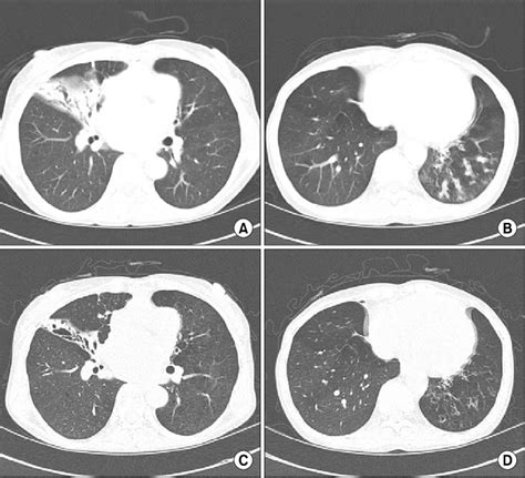 Chest Ct Scan Showed Bronchiectasis And Combined Bronchopneumonia In