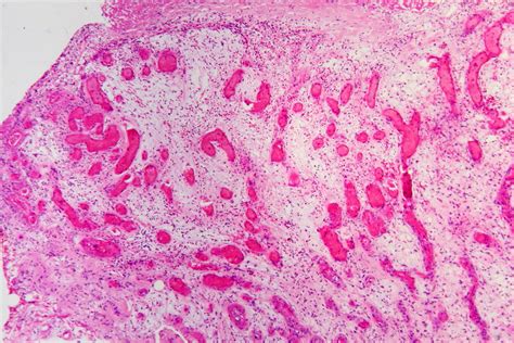Filegranulation Tissue In An Infected Wound He 1 Libre Pathology