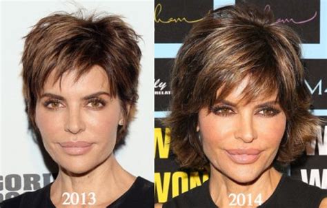 Lisa Rinna Plastic Surgery Before And After Photos Latest Plastic