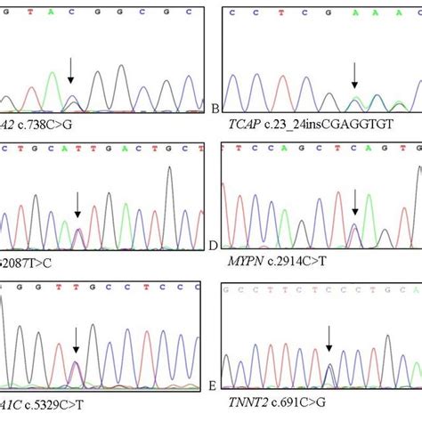 Sanger Sequencing Confirmation Of The Variants Detected By Whole Exome Download Scientific