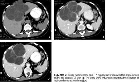 Benign Biliary Neoplasms 731 Mri Of The Liver Doctor Steve Abel